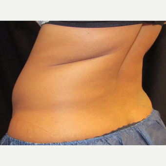41 yr old woman treated with CoolSculpting on the flanks. before 3349667