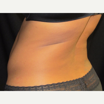41 yr old woman treated with CoolSculpting on the flanks. after 3349667