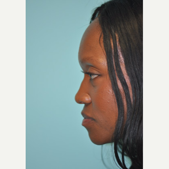 35-44 year old woman treated with Non Surgical Nose Job before 3332500