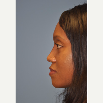 35-44 year old woman treated with Non Surgical Nose Job after 3332500
