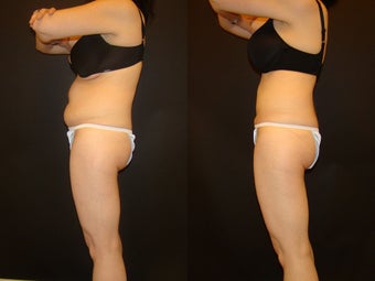 44 Year Old Female with SmartLipo to her abdomen before 1011862