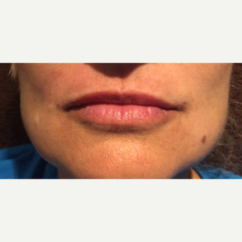 45-54 year old woman treated with Restylane Silk after 3466529