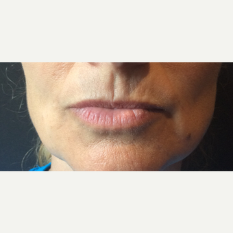 45-54 year old woman treated with Restylane Silk before 3466529