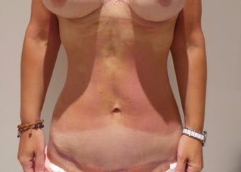 35-44 year old woman treated with Tummy Tuck after 3718283