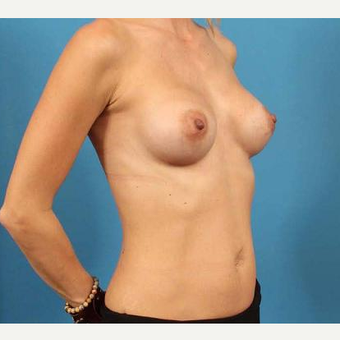 25-34 year old woman treated with Breast Implants after 3076299