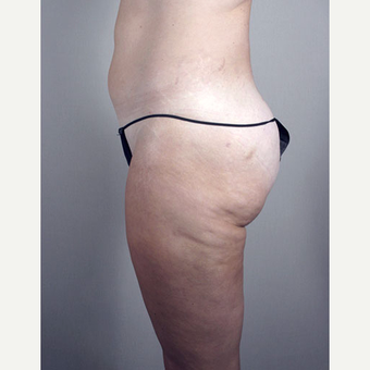 25-34 year old woman treated with Brazilian Butt Lift after 3213407