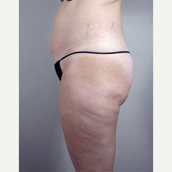 25-34 year old woman treated with Brazilian Butt Lift before 3213407