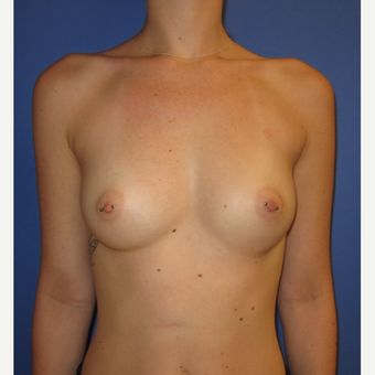 18-24 year old woman treated with Breast Augmentation (one week after surgery) before 3180531
