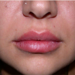 25 year old woman treated with Lip Augmentation after 2842422
