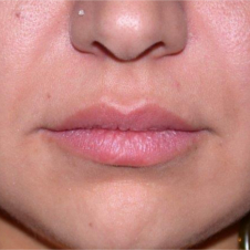 25 year old woman treated with Lip Augmentation before 2842422