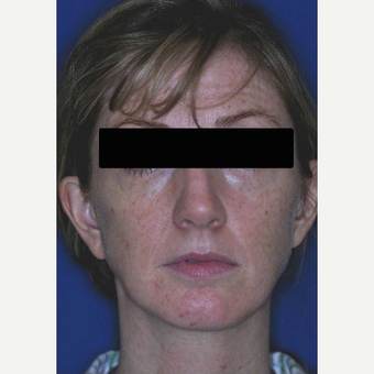 45-54 year old female treated with Revision Rhinoplasty before 3669945