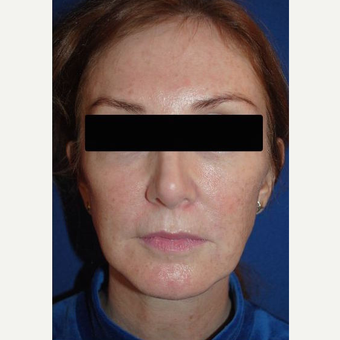 45-54 year old female treated with Revision Rhinoplasty after 3669945