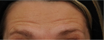Before and After BOTOX® Cosmetic - frown lines, forehead lines, crow's feet before 631340