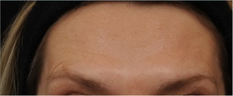 Before and After BOTOX® Cosmetic - frown lines, forehead lines, crow's feet after 631340