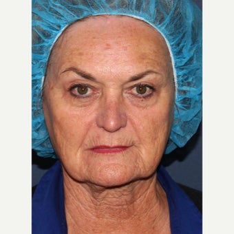 65-74 year old woman treated with ThermiTight before 2155812