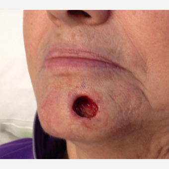 65-74 year old woman treated with Facial Reconstructive Surgery before 3520931