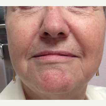 65-74 year old woman treated with Facial Reconstructive Surgery after 3520931