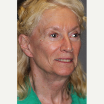 65-74 year old woman treated with Eyelid Surgery after 3286735