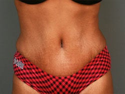 Tummy Tuck after 160226
