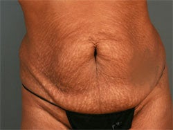 Tummy Tuck before 160226