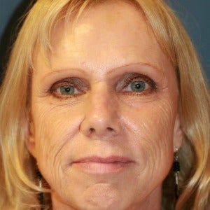 55-64 year old woman treated with Skin Rejuvenation before 2448905