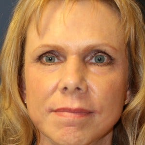 55-64 year old woman treated with Skin Rejuvenation after 2448905