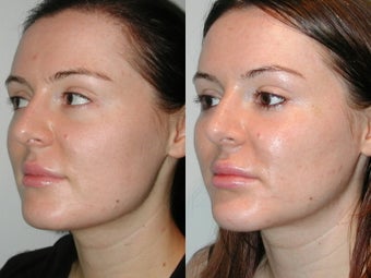 28 Year Old Female with Cheek and Chin Implants after 1077179