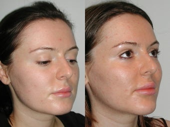 28 Year Old Female with Cheek and Chin Implants 1077179