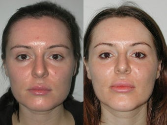 28 Year Old Female with Cheek and Chin Implants before 1077179