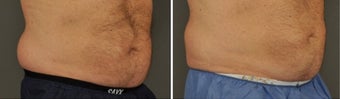 45-54 year old man treated with CoolSculpting before 3054908