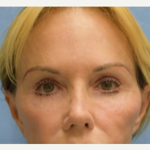 65-74 year old woman treated with Fat Transfer before 3605291