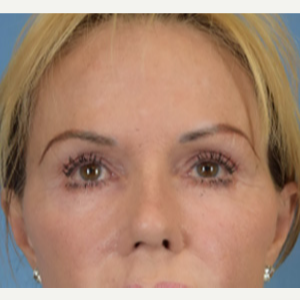 65-74 year old woman treated with Fat Transfer after 3605291