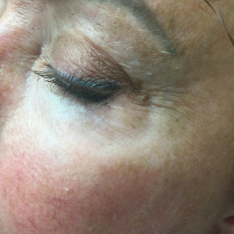 45-54 year old woman treated with Vein Treatment after 3079332