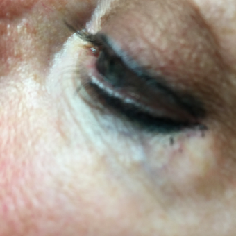 45-54 year old woman treated with Vein Treatment before 3079332