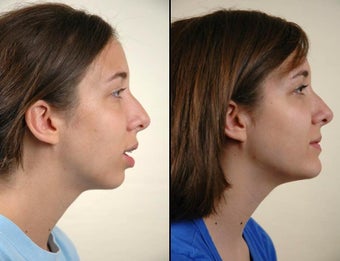 Chin Augmentation before 1199833