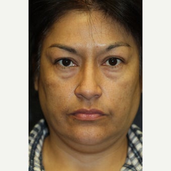 45-54 year old woman treated with Glycolic Peel before 1555602