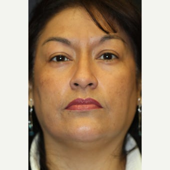 45-54 year old woman treated with Glycolic Peel after 1555602