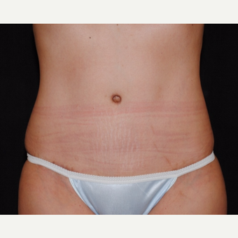 37 year old mother of two undergoes tummy tuck and laser liposuction after 2967891