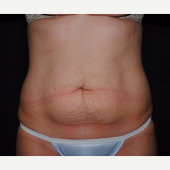 37 year old mother of two undergoes tummy tuck and laser liposuction before 2967891