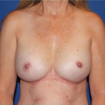 45-54 year old woman treated with Breast Reconstruction after 1982483