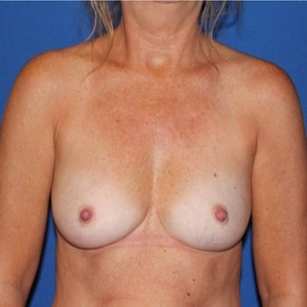45-54 year old woman treated with Breast Reconstruction before 1982483