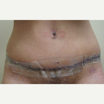 Embrace Scar Therapy on Mommy Makeover Patient before 3489200