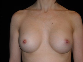 43 year old dentist wanted slightly smaller implants after 955401