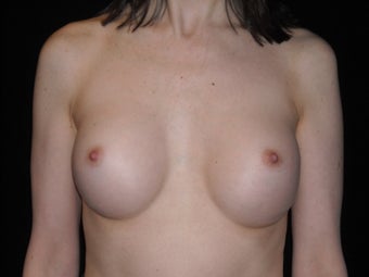 43 year old dentist wanted slightly smaller implants before 955401