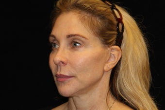 45-54 year old woman treated with Non Surgical Face Lift 3502181