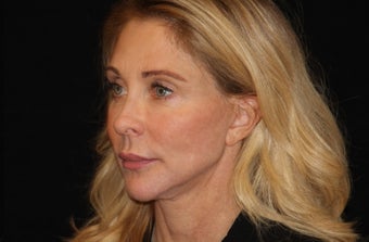 45-54 year old woman treated with Non Surgical Face Lift 3502181