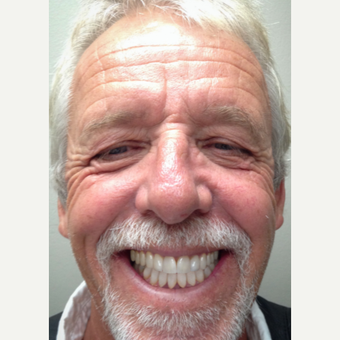 35-44 year old man treated with Porcelain Veneers after 3324946