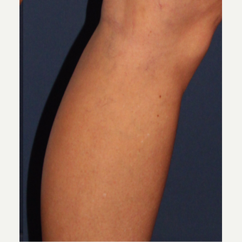 35-44 year old woman treated with Sclerotherapy after 3110216