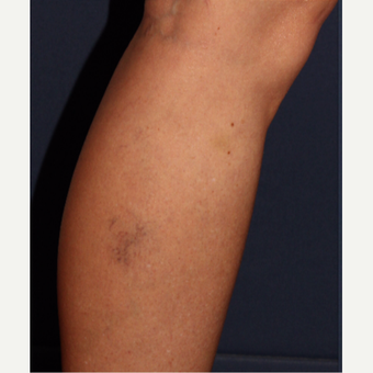 35-44 year old woman treated with Sclerotherapy before 3110216