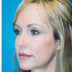 45-54 year old woman treated with Cheek Augmentation after 1726694
